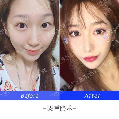 重睑术明星,美丽蜕变背后的秘密